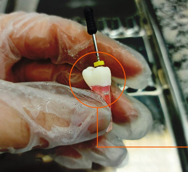 Descubra Os Dentes Diferenciados De Endodontia E Cariados Da Pronew