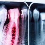 (Português do Brasil) Descubra os Dentes Diferenciados de Endodontia e Cariados da Pronew